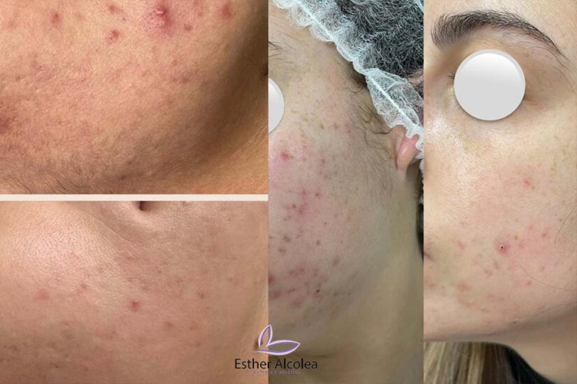 Acné, tratamientos en Esther Alcolea, centro de estética