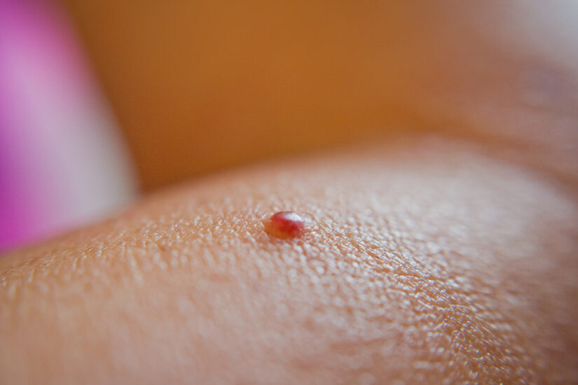 Cómo tratar puntos de rubí